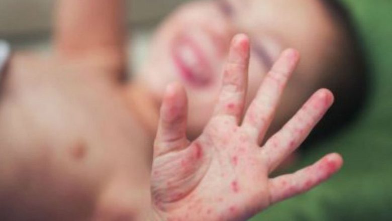 दुई बालकमा दादुरा–रुबेला